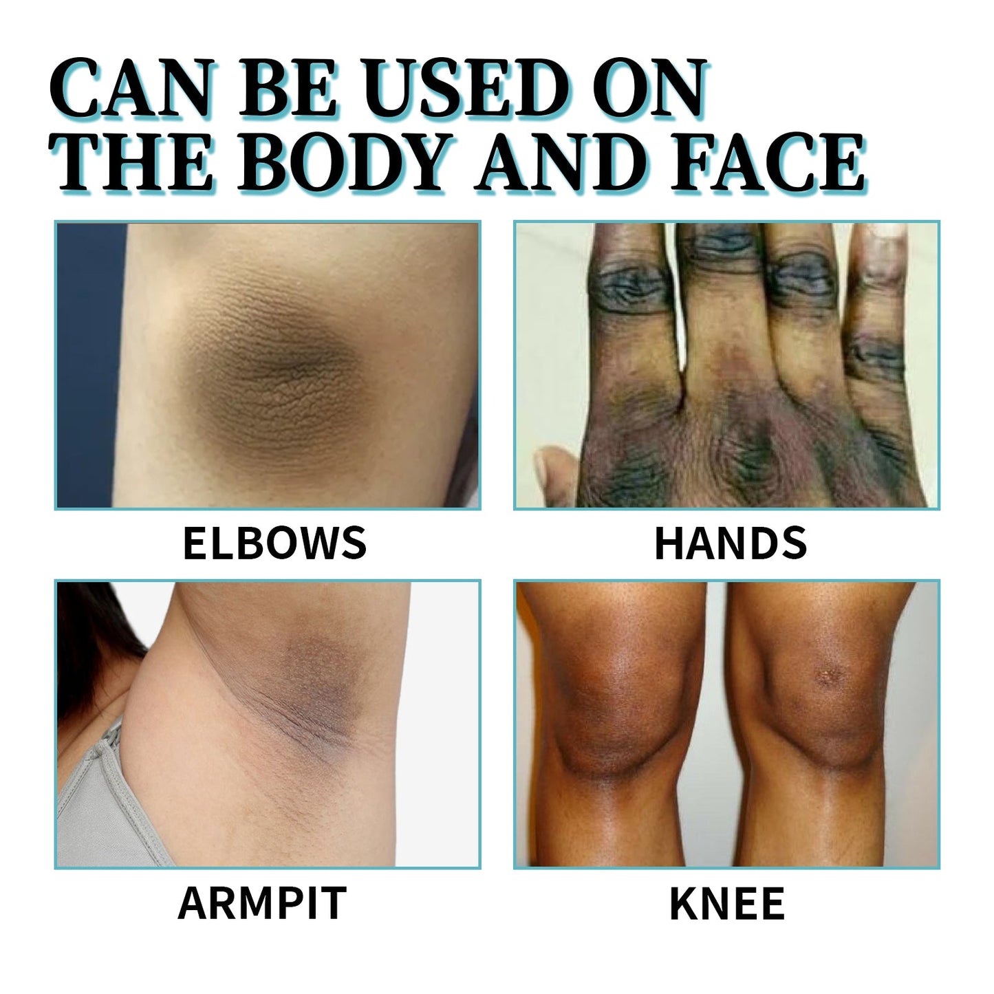 OUHOE Acanthosis Nigricans Therapy Lotion, Skin Moisturizing Clean Black Dark Heavy Alar Knee Joint Repair Carry Bright Color Of Skin