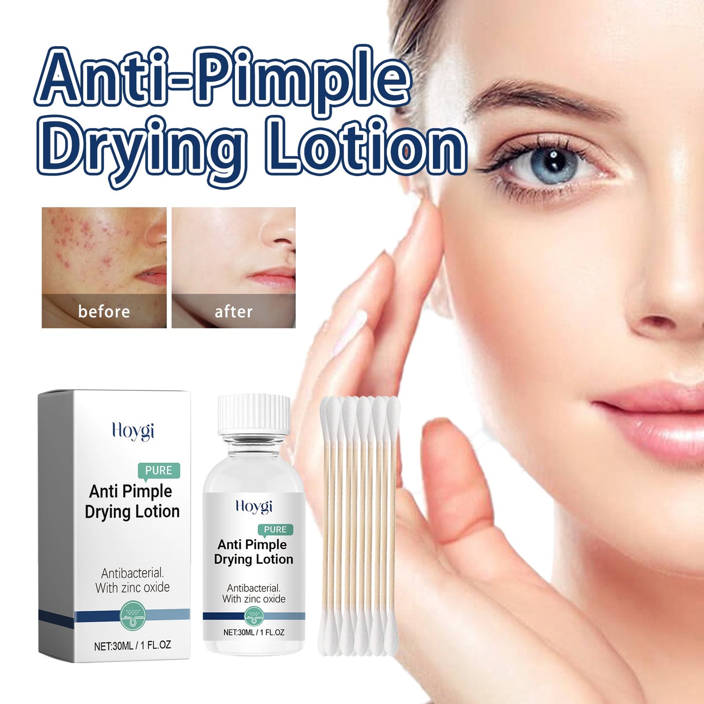 Hoygi Anti-Pimple Drying Lotion, Facial Cleansing And Repair Lighten Acne Marks And Pits, Close Your Mouth And Mild Skin Cream