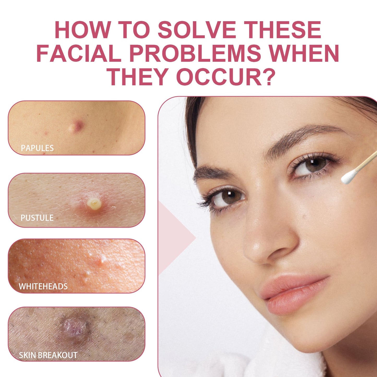 OUHOE Salicylic Acid Acne Lotion Gently Cares For Acne-Prone Skin, Refines Pores And Moisturizes Facial Skin