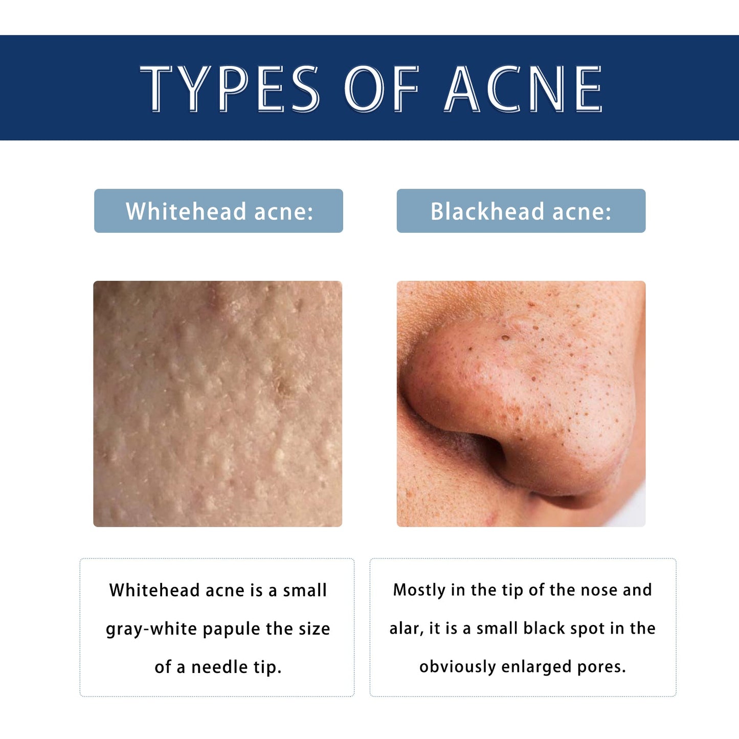 Hoygi Anti-Pimple Drying Lotion, Facial Cleansing And Repair Lighten Acne Marks And Pits, Close Your Mouth And Mild Skin Cream