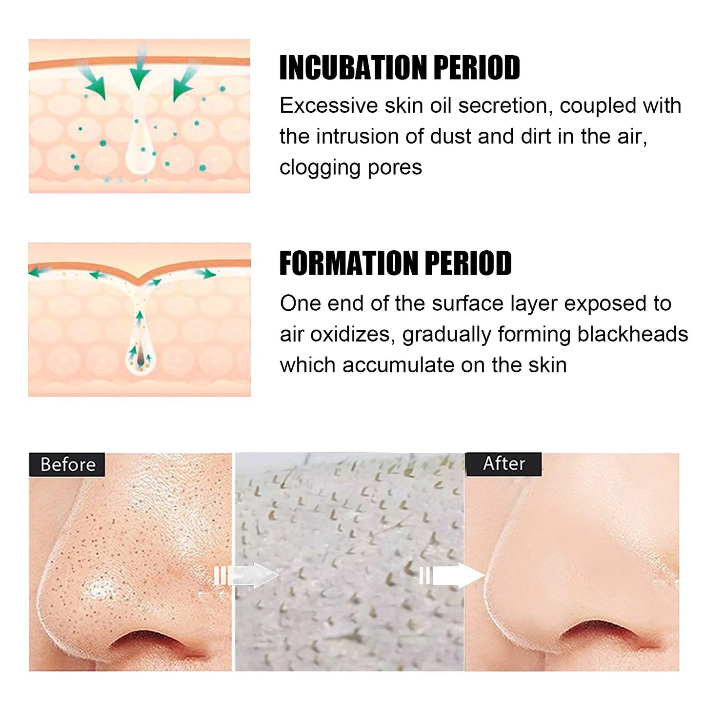 EELHOE Blackhead Remover Nose Mask, Deeply Cleans And Closes Pore Blackheads And Acne Barbs And Nose Remover Mask